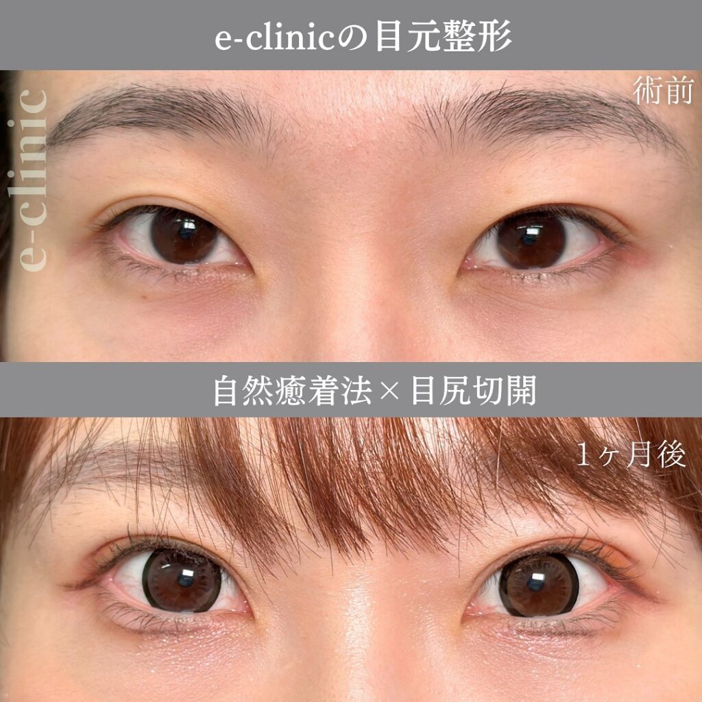 自然癒着法と目尻切開の症例
