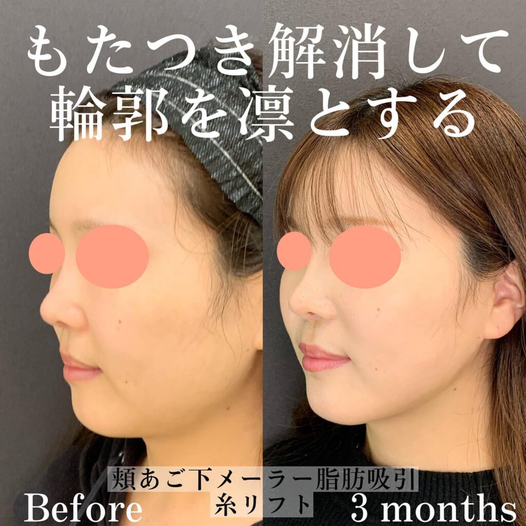 eclinic京都院の糸リフト症例写真