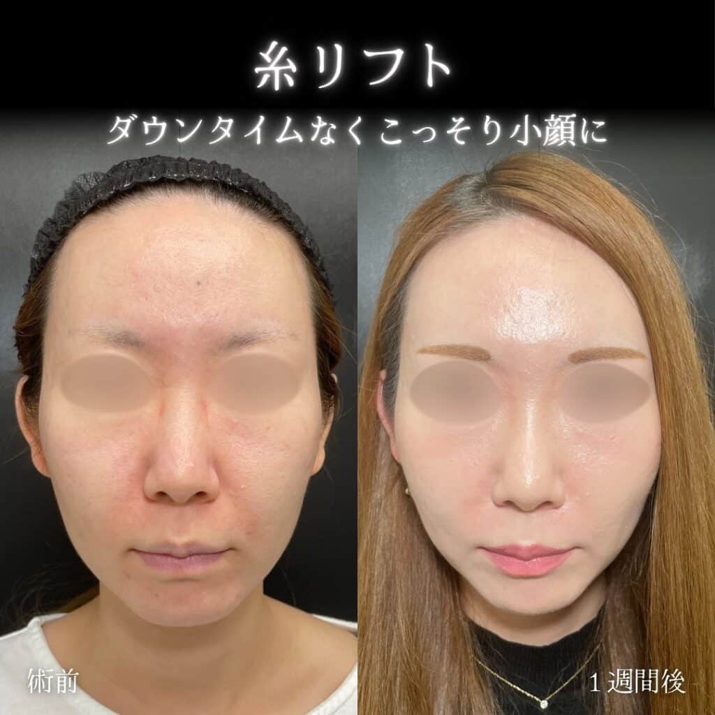 糸リフトの症例写真