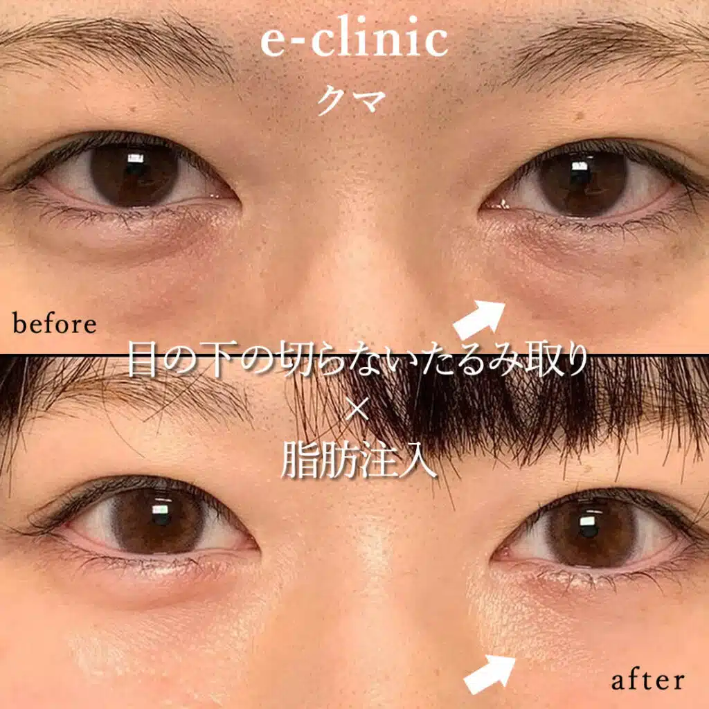 eclinic京都院の表ハムラの症例画像(1)