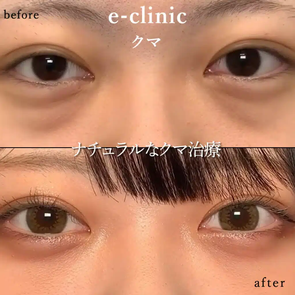eclinic京都院の表ハムラの症例画像(2)