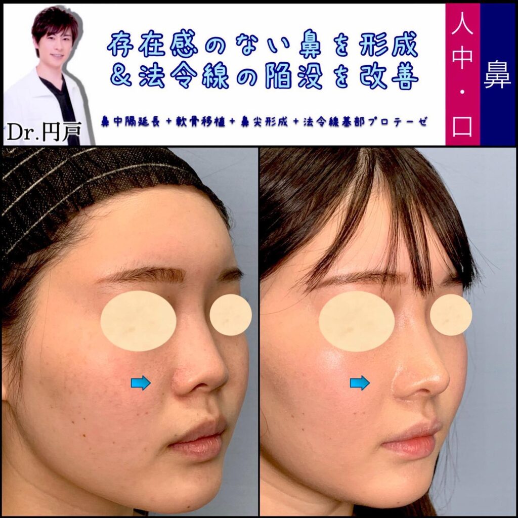 鼻中隔延長と軟骨移植と鼻尖形成と貴族手術の症例写真