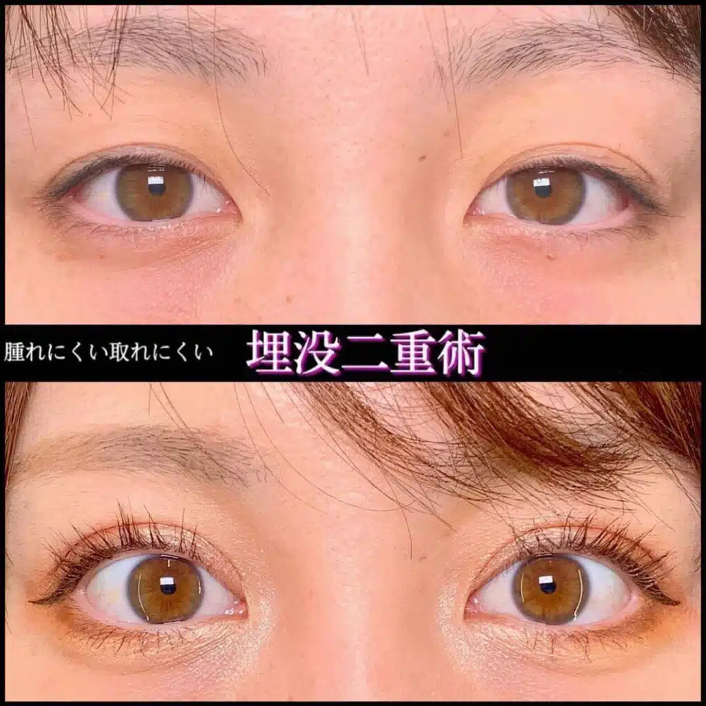 腫れにくい取れにくい 埋没二重術 京都