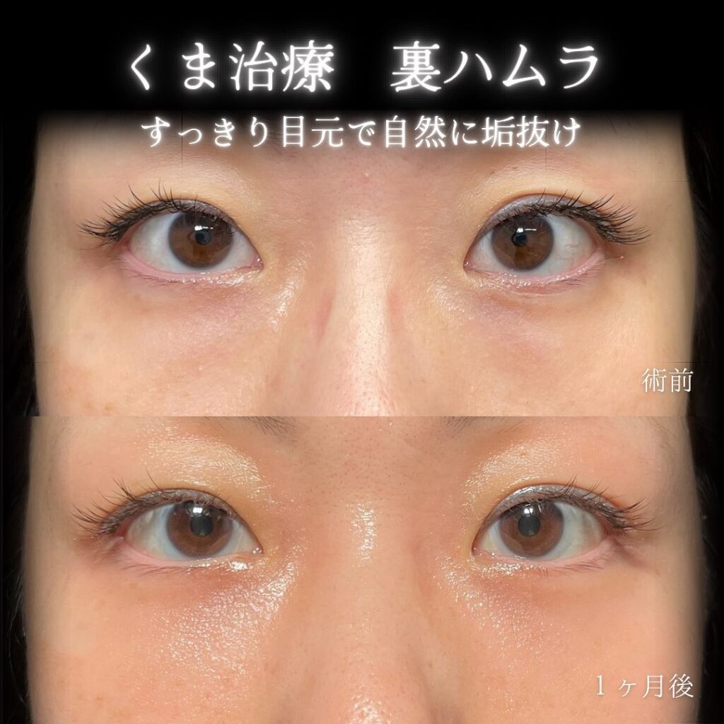 eclinic京都院の表ハムラの症例画像(4)