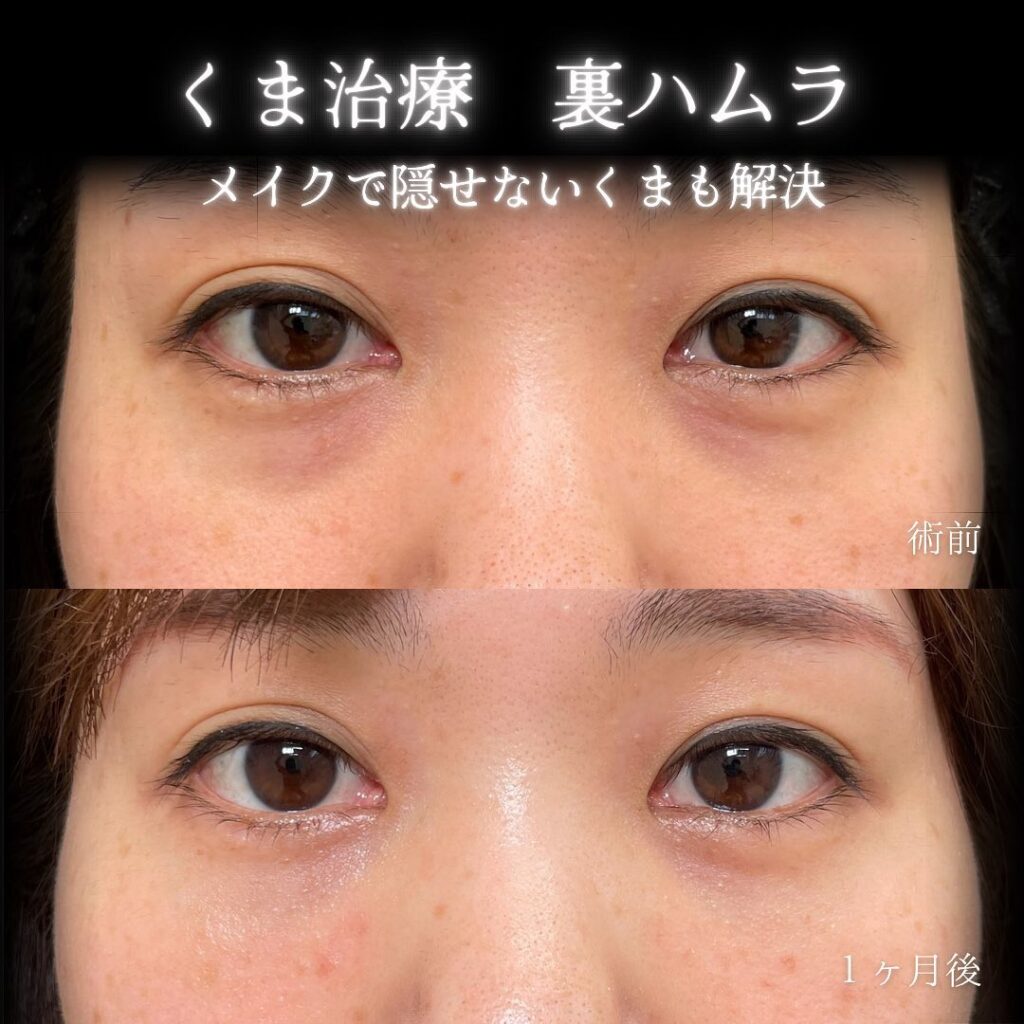 eclinic京都院の表ハムラの症例画像(5)