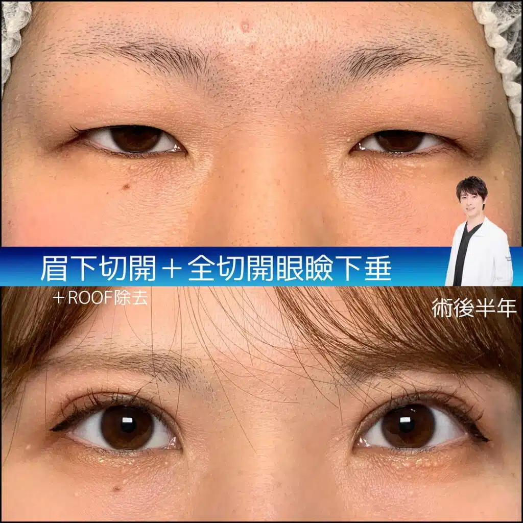 眉下切開 全切開眼瞼下垂 ROOF除去 京都