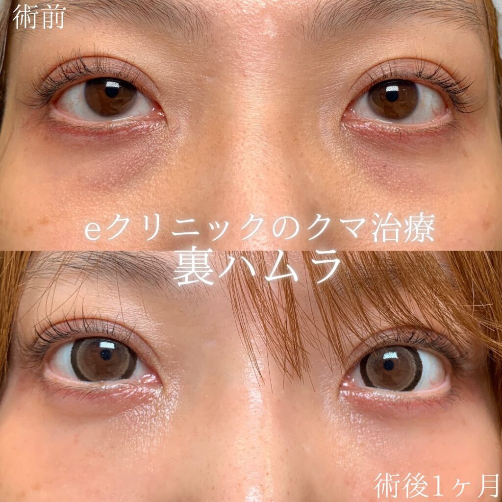 eクリニック京都院の裏ハムラの症例画像(1)