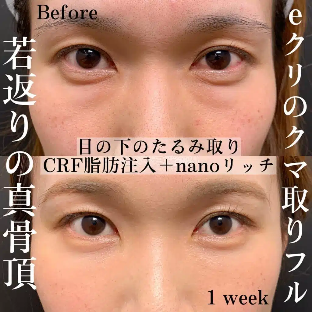 目の下のたるみ取り CRF脂肪注入 nanoリッチ 京都