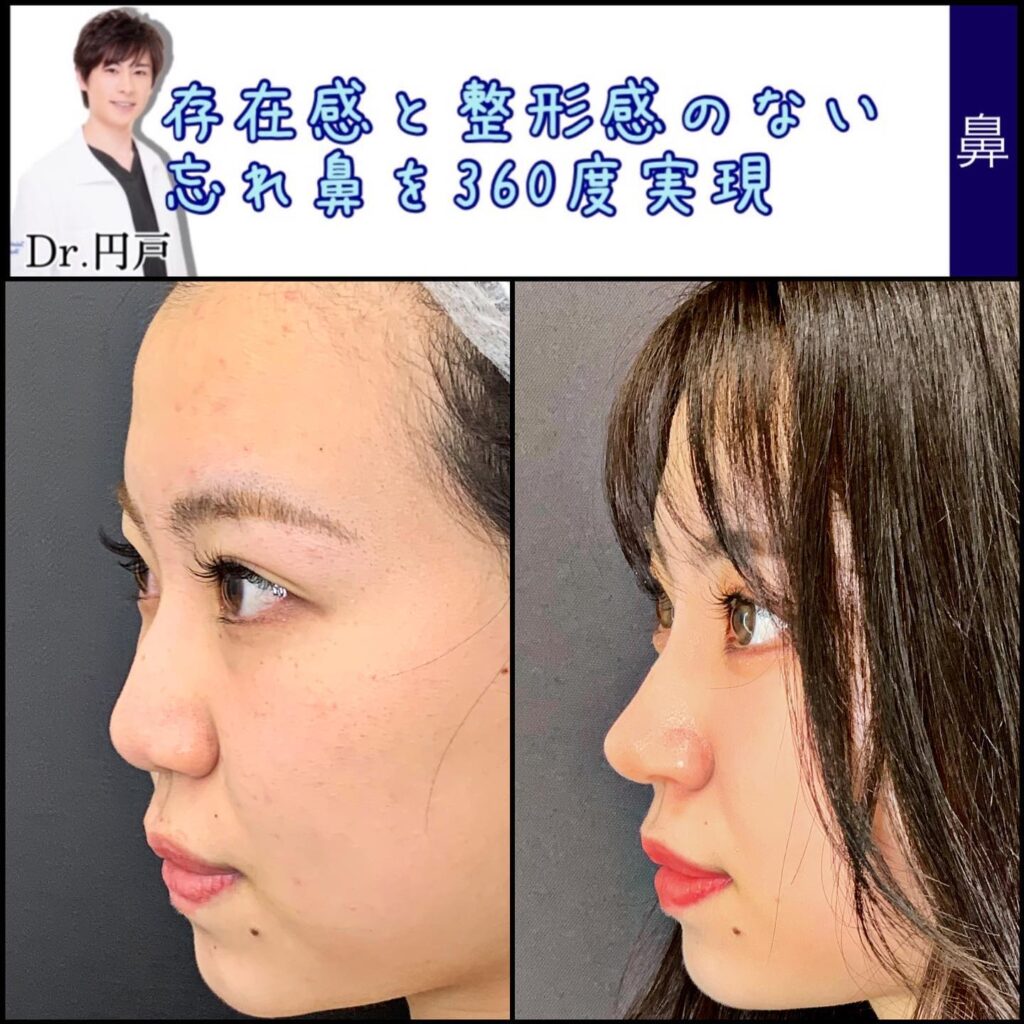 鼻尖形成と軟骨移植と鼻中隔延長と法令線基部人口真皮と鼻背部軟骨以上と小鼻縮小の症例写真 (4)