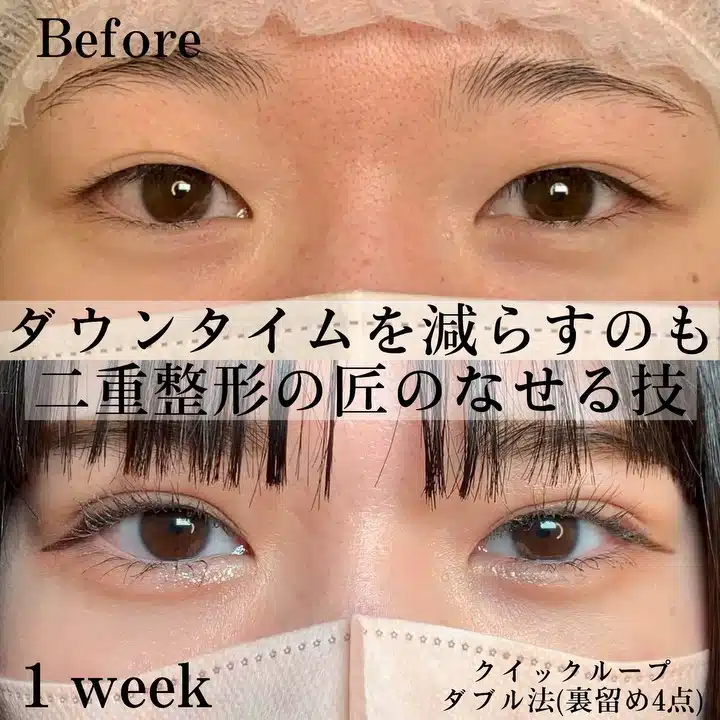 クイックループダブル法(裏留め4点) 京都