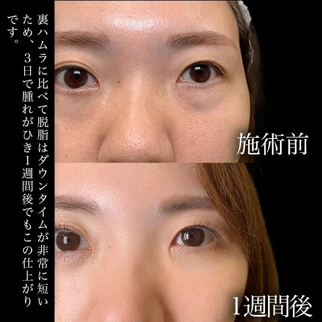 経結膜脱脂 京都