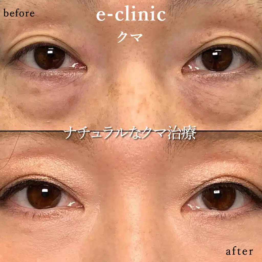 eclinic京都院の表ハムラの症例画像(3)