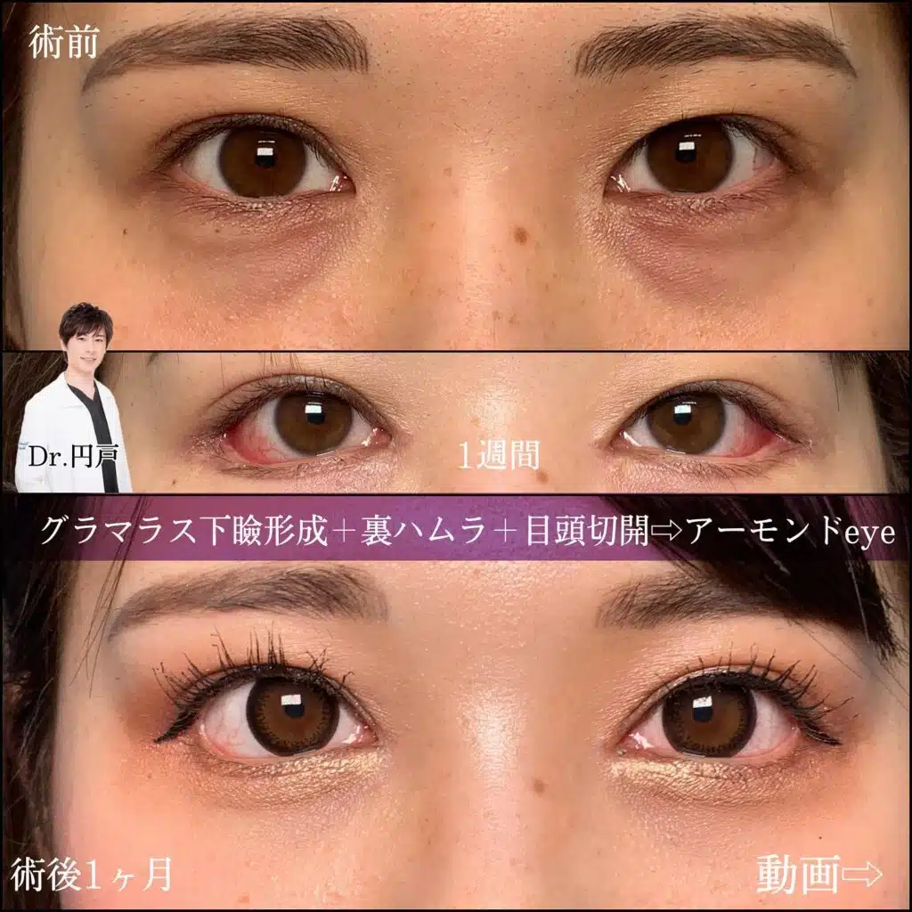 グラマラス下瞼形成 裏ハムラ 目頭切開 京都