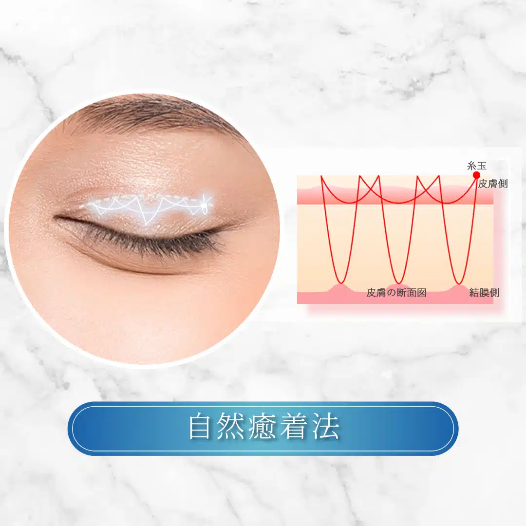 自然癒着法　京都