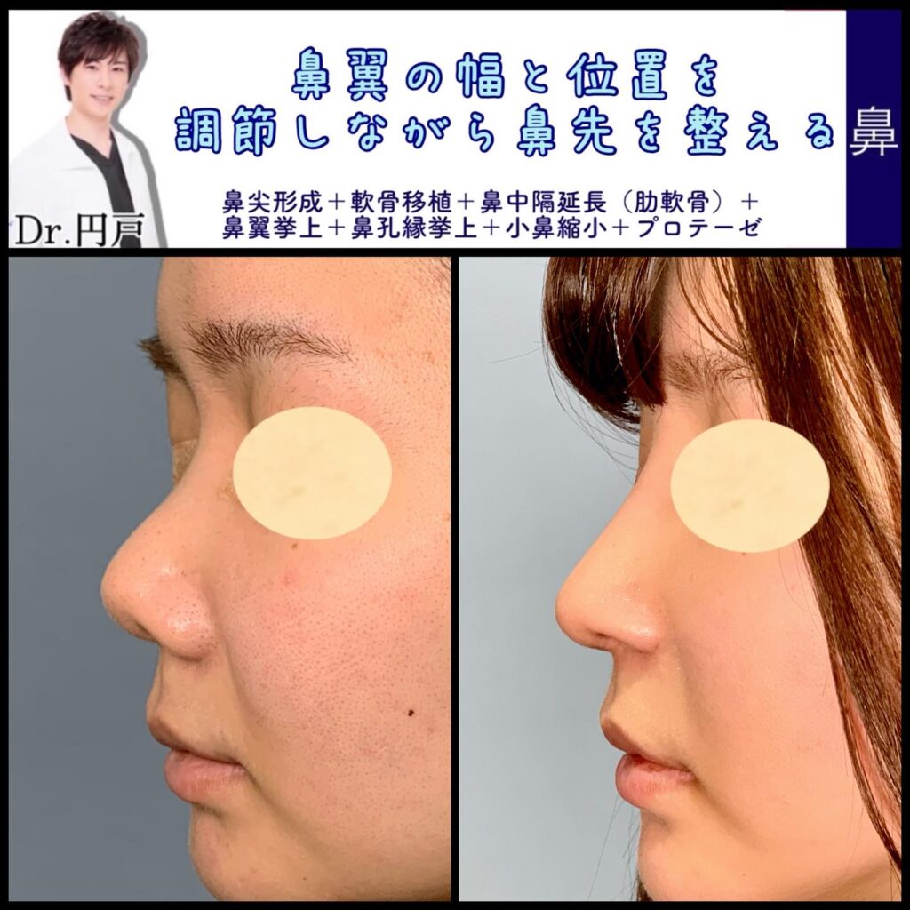 鼻尖形成と軟骨移植と鼻中隔延長と鼻翼挙上と鼻孔縁挙上と小鼻縮小と鼻のプロテーゼの症例写真
