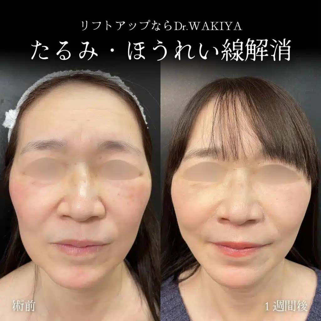 たるみ・ほうれい線解消 京都
