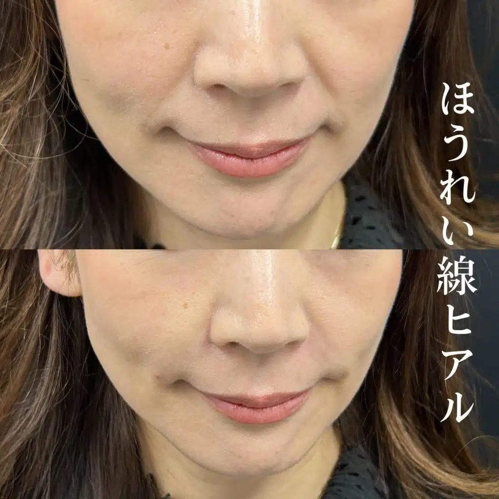ほうれい線ヒアル 京都