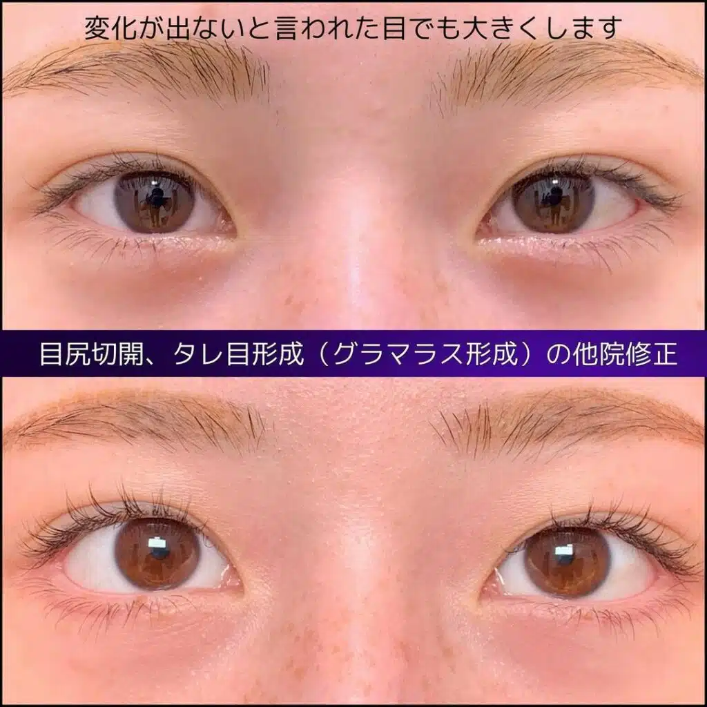 目尻切開 タレ目形成(グラマラス形成) 他院修正 京都