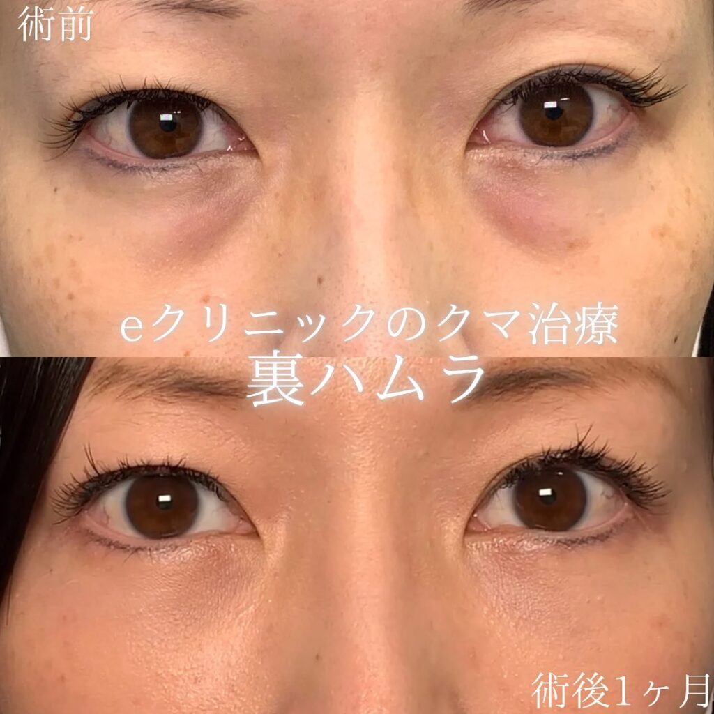 eクリニック京都院の裏ハムラの症例画像(3)