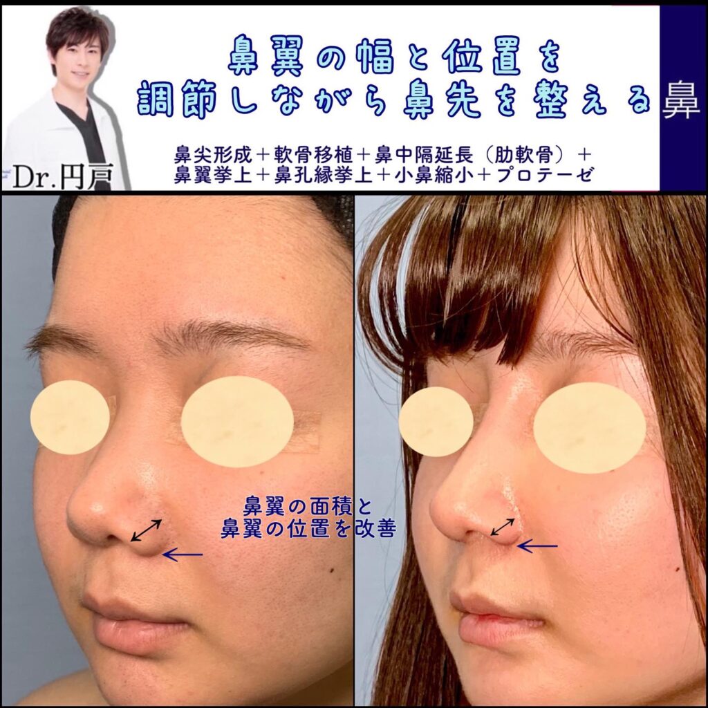 鼻尖形成と軟骨移植と鼻中隔延長と鼻翼挙上と鼻孔縁挙上と小鼻縮小とプロテーゼの症例写真
