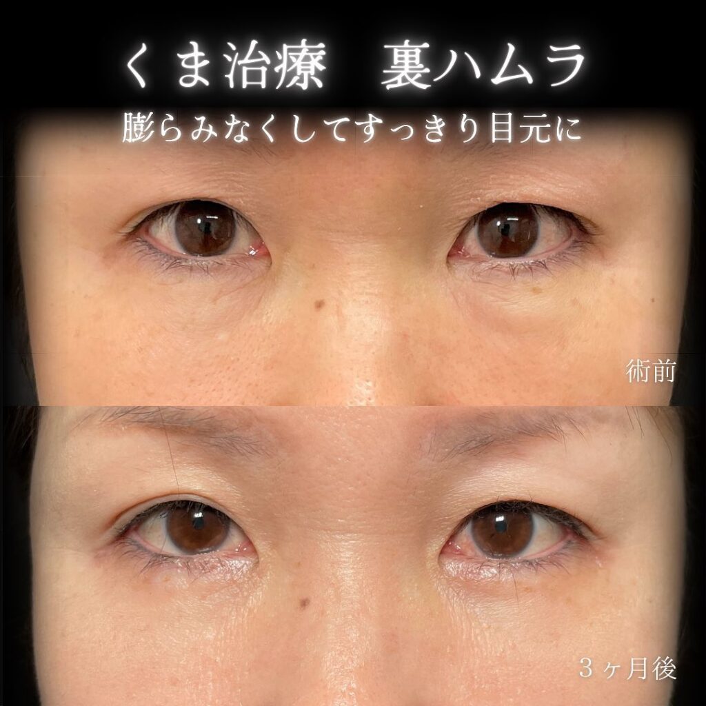 eclinic京都院の表ハムラの症例画像(6)