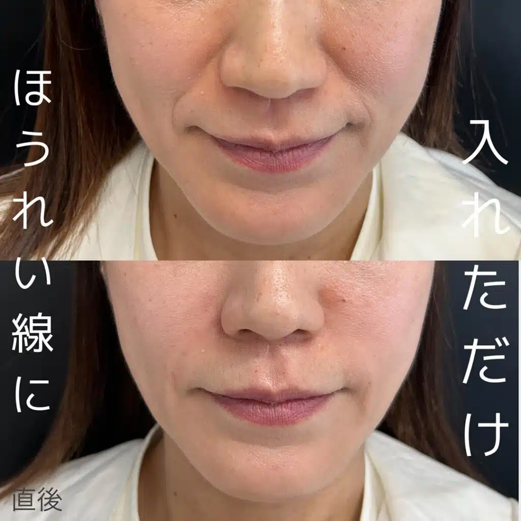 ほうれい線に入れただけ 京都