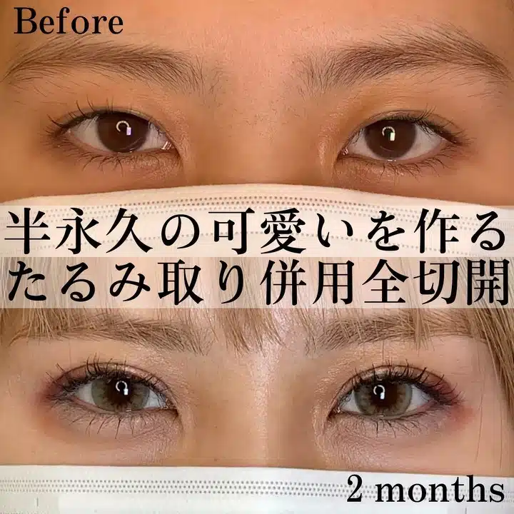 たるみ取り併用全切開 京都