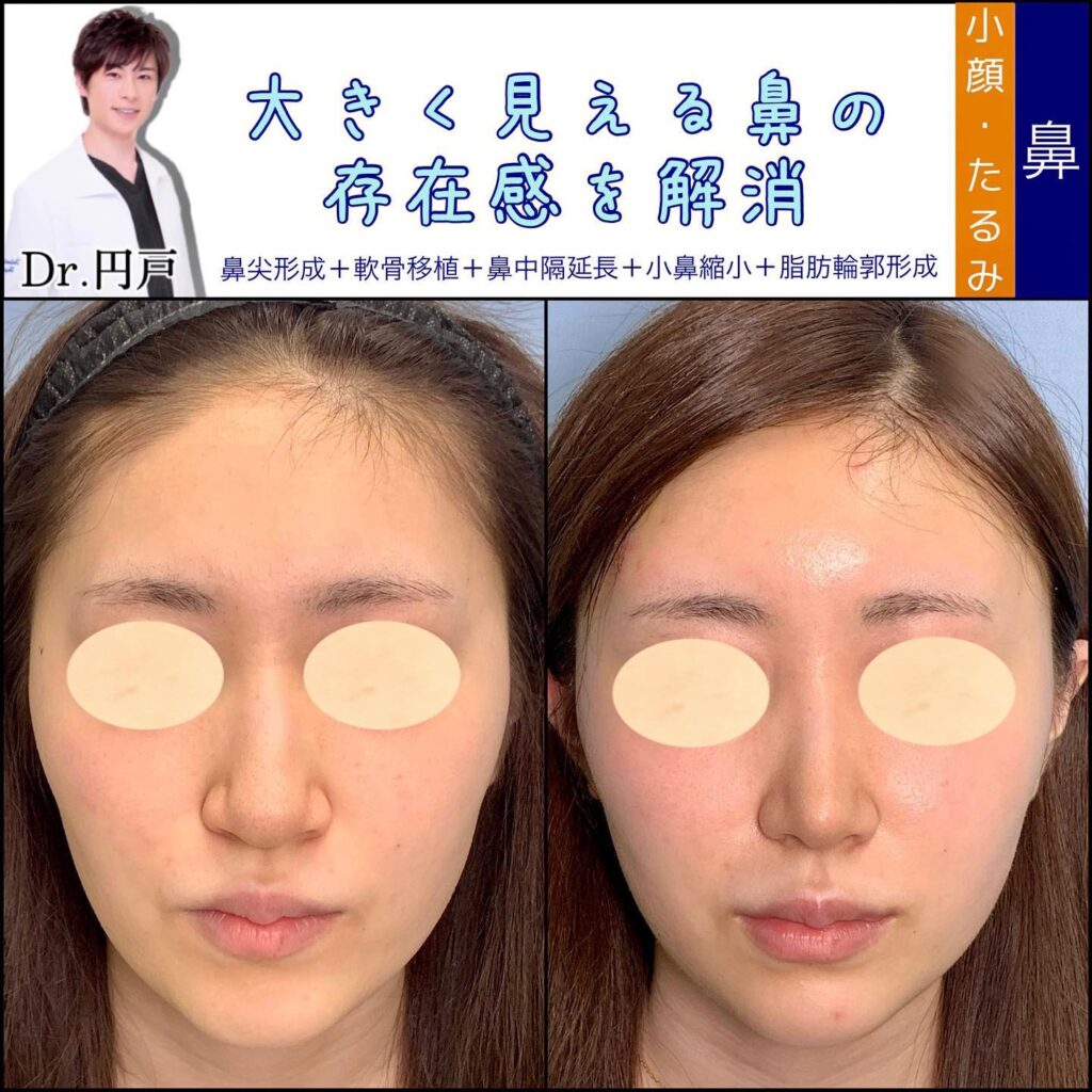 小鼻縮小と鼻尖形成を同時に行った症例