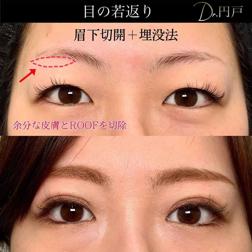 眉下切開 埋没法 京都