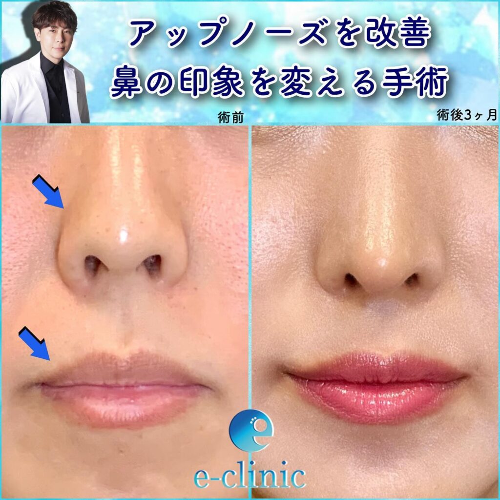 鼻尖形成と軟骨移植と鼻中隔延長と口角挙上と顎ヒアルロン酸の症例写真 (1)