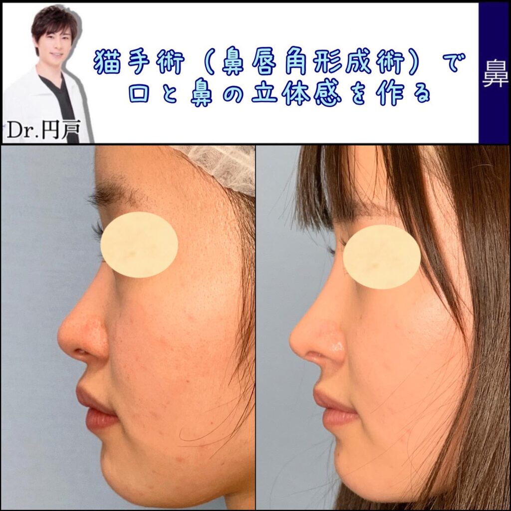 鼻唇角形成術（猫手術）併用した肋軟骨での鼻中隔延長の手術の3ヶ月後 (1)