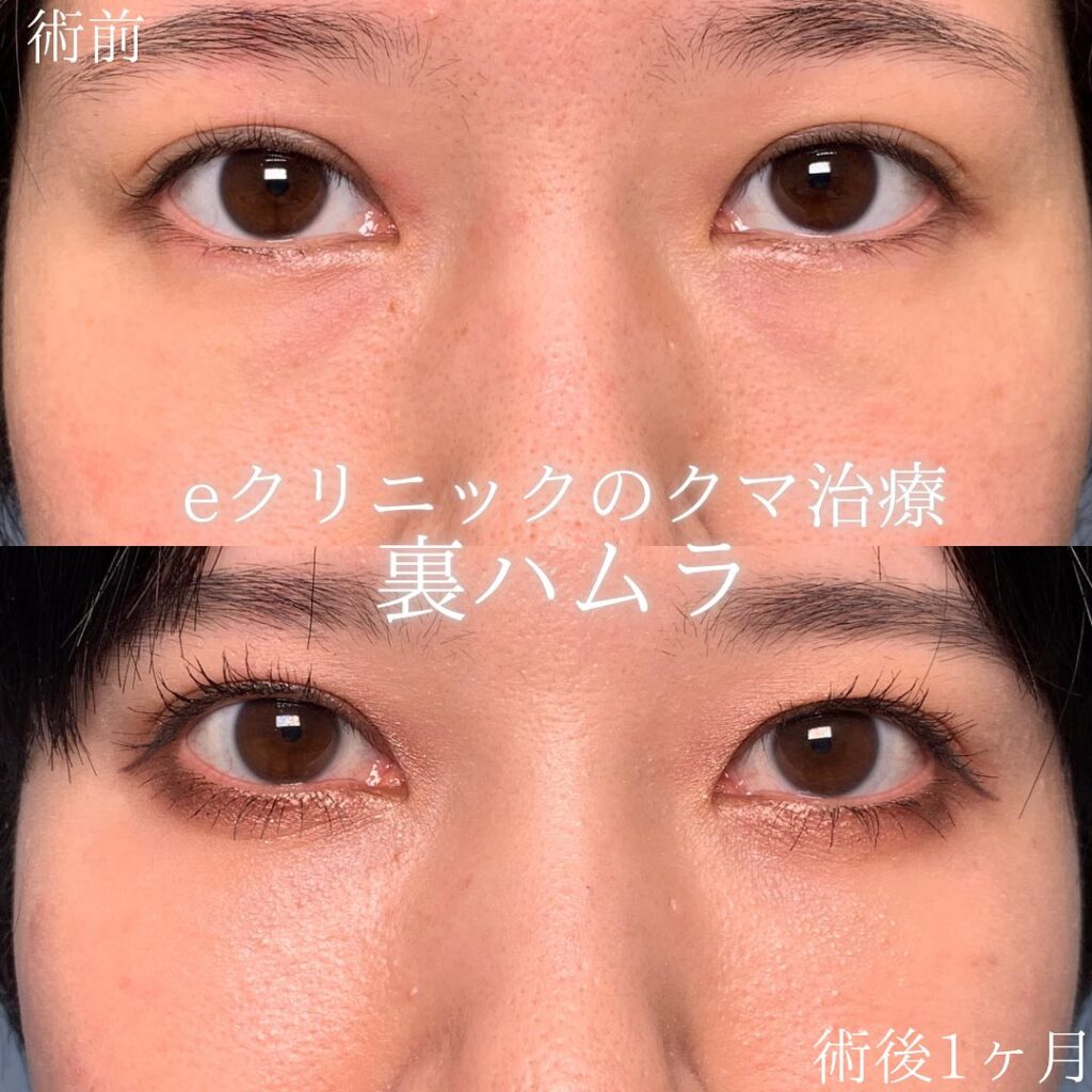 eクリニック京都院の裏ハムラの症例画像(2)