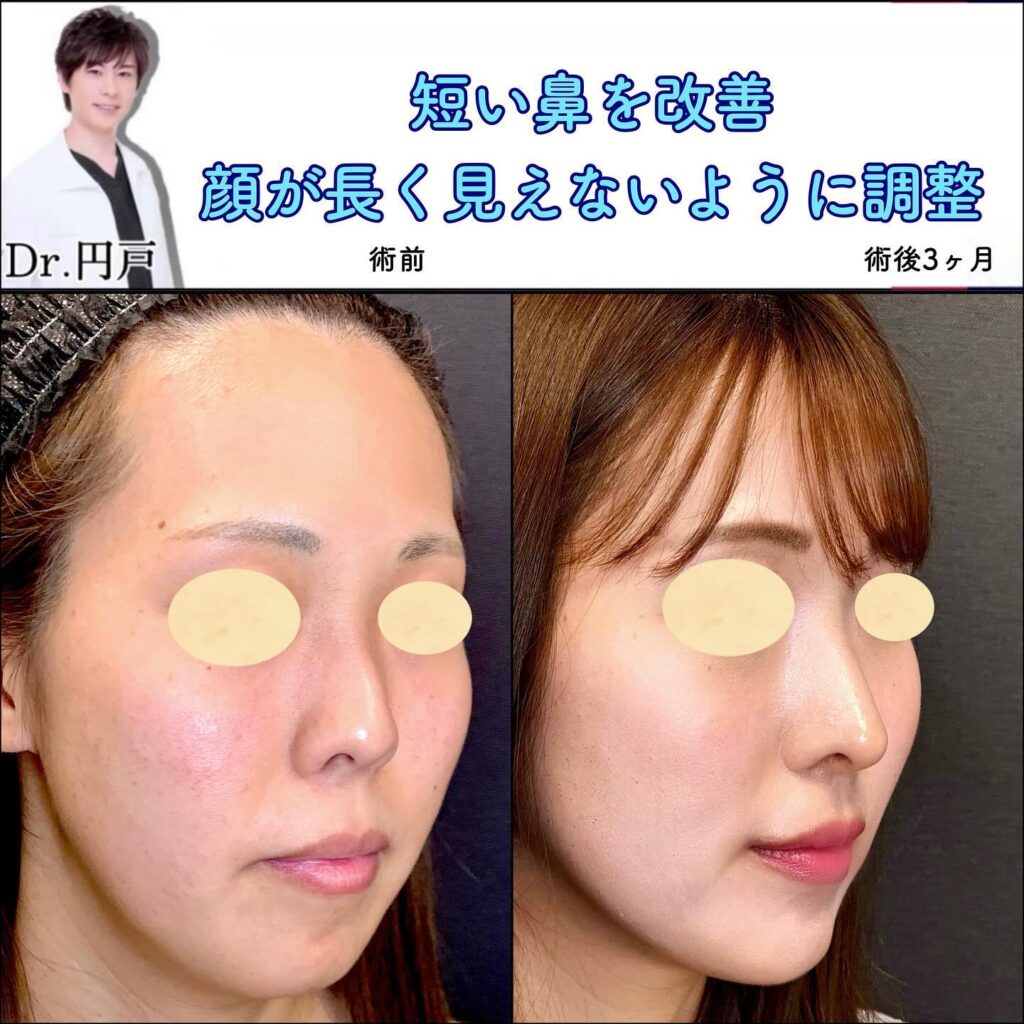 鼻尖形成と軟骨移植と鼻中隔延長と口角挙上と顎ヒアルロン酸の症例写真