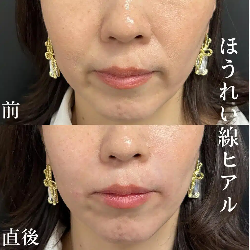 ほうれい線ヒアル 京都