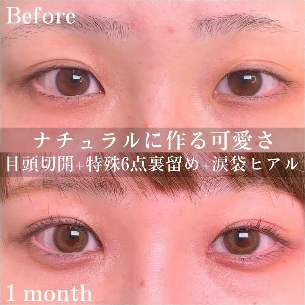 目頭切開 特殊6点裏留め 涙袋ヒアル 京都