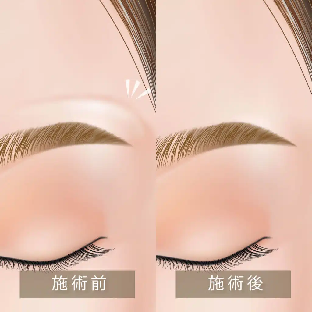眉上ボトックス 京都