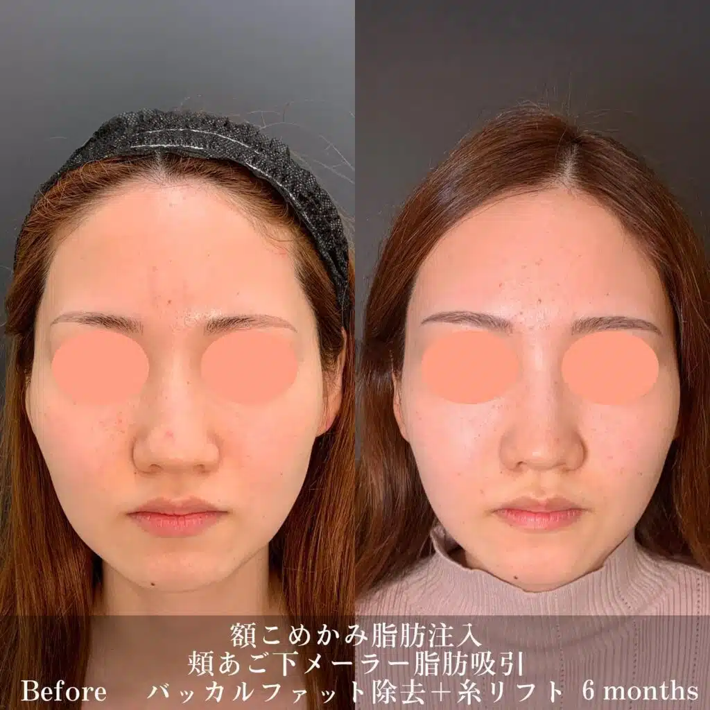 額こめかみ脂肪注入 頬あご下メーラー脂肪吸引 バッカルファット除去+糸リフト 京都
