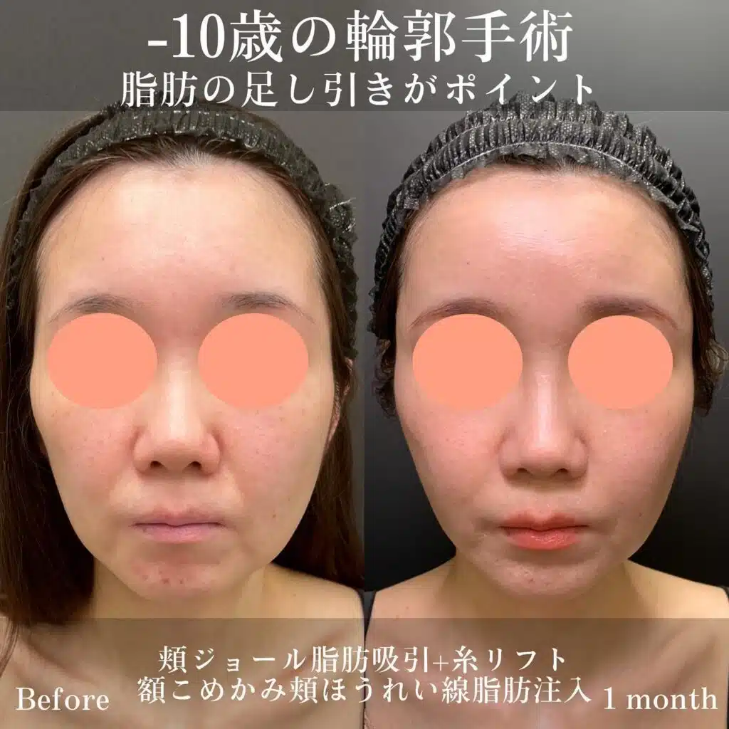 頬ジョール脂肪吸引+糸リフト 額こめかみ頬ほうれい線脂肪注入 京都