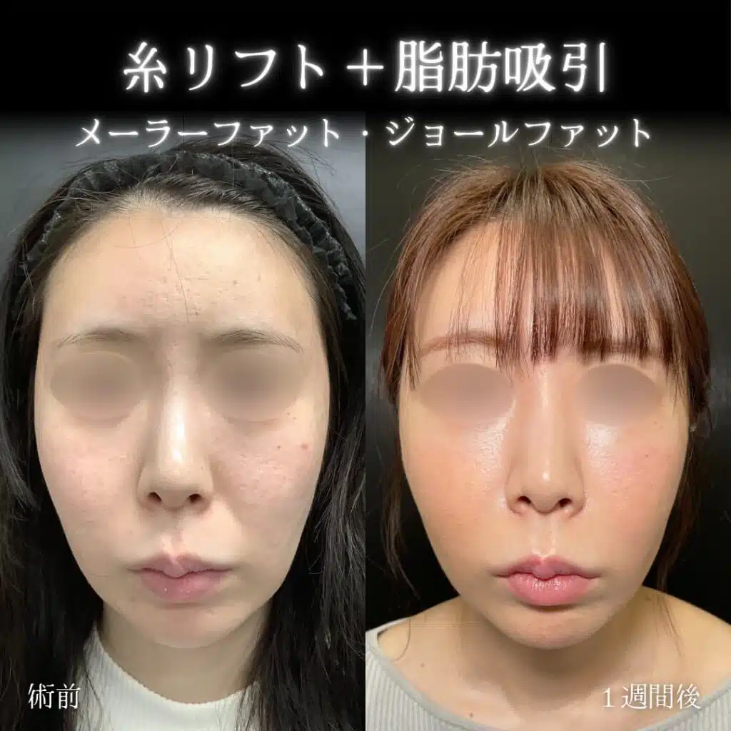 糸リフト+脂肪吸引 京都