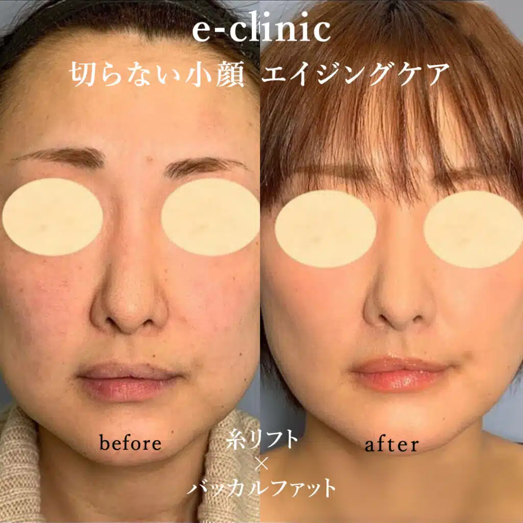 切らない小顔 エイジングケア 糸リフト×バッカルファット 京都