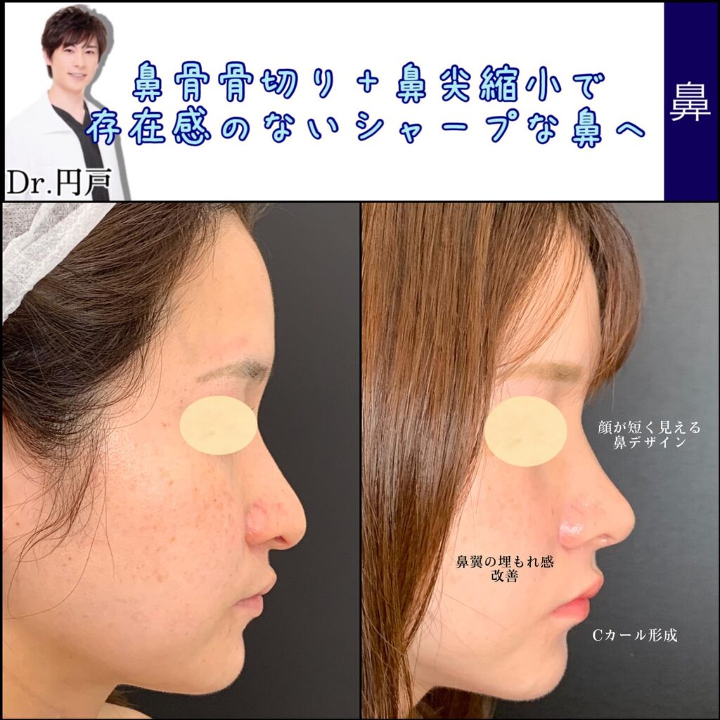 鼻骨骨切りと鼻尖形成の症例写真 (3)