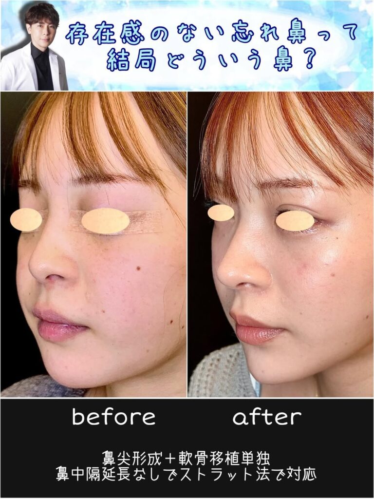 鼻尖形成と軟骨移植単独の症例写真 (3)