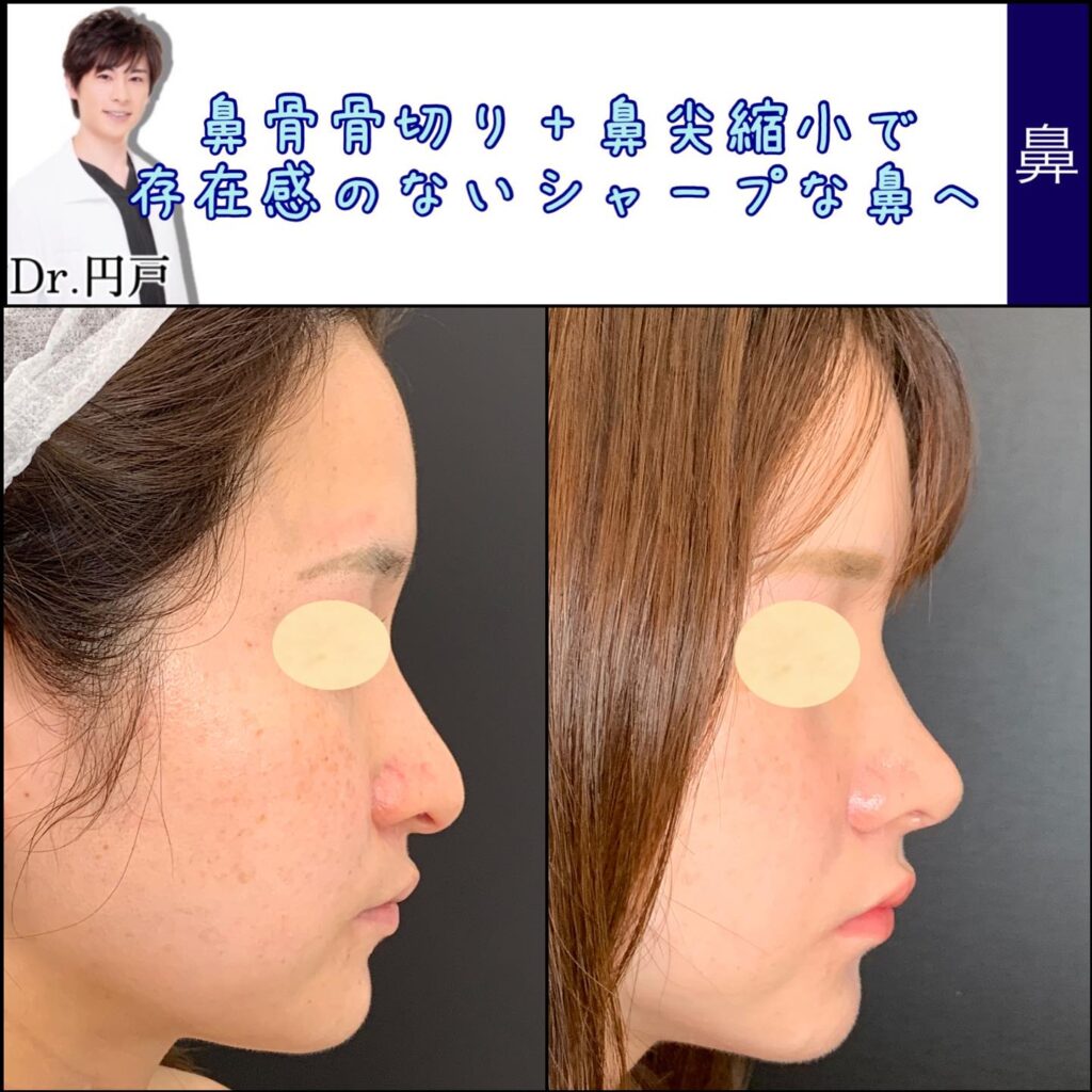 鼻骨骨切りと鼻尖形成の症例写真 (2)