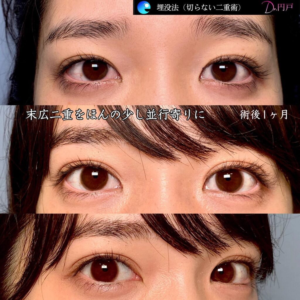 埋没法の症例写真 (9)