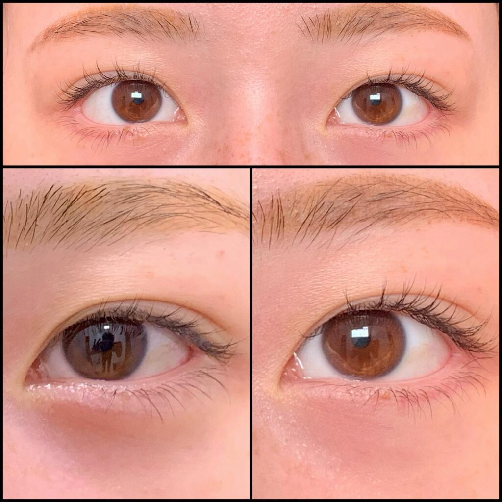 タレ目形成と目尻切開の症例写真 (6)