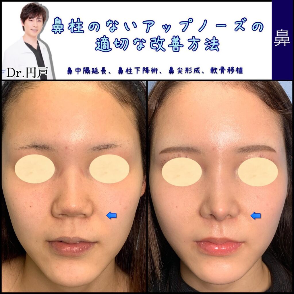 鼻中隔延長と軟骨移植と鼻尖形成と鼻柱下降の症例写真 (2)