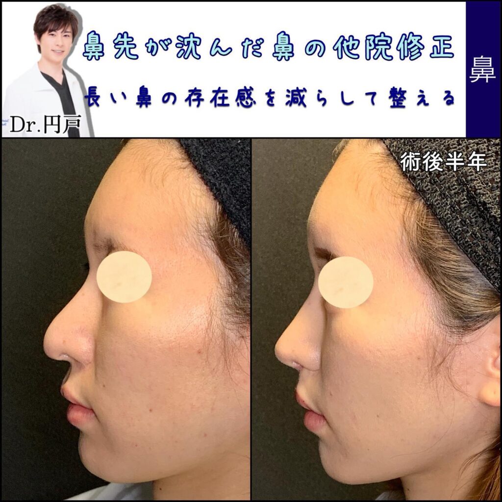 鼻の他院修正の症例写真 (11)