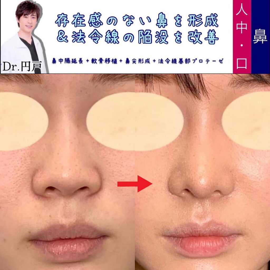 鼻中隔延長と軟骨移植お鼻尖形成と貴族手術の症例写真 (2)