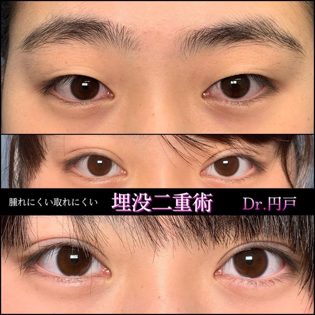 埋没法の症例写真 (19)