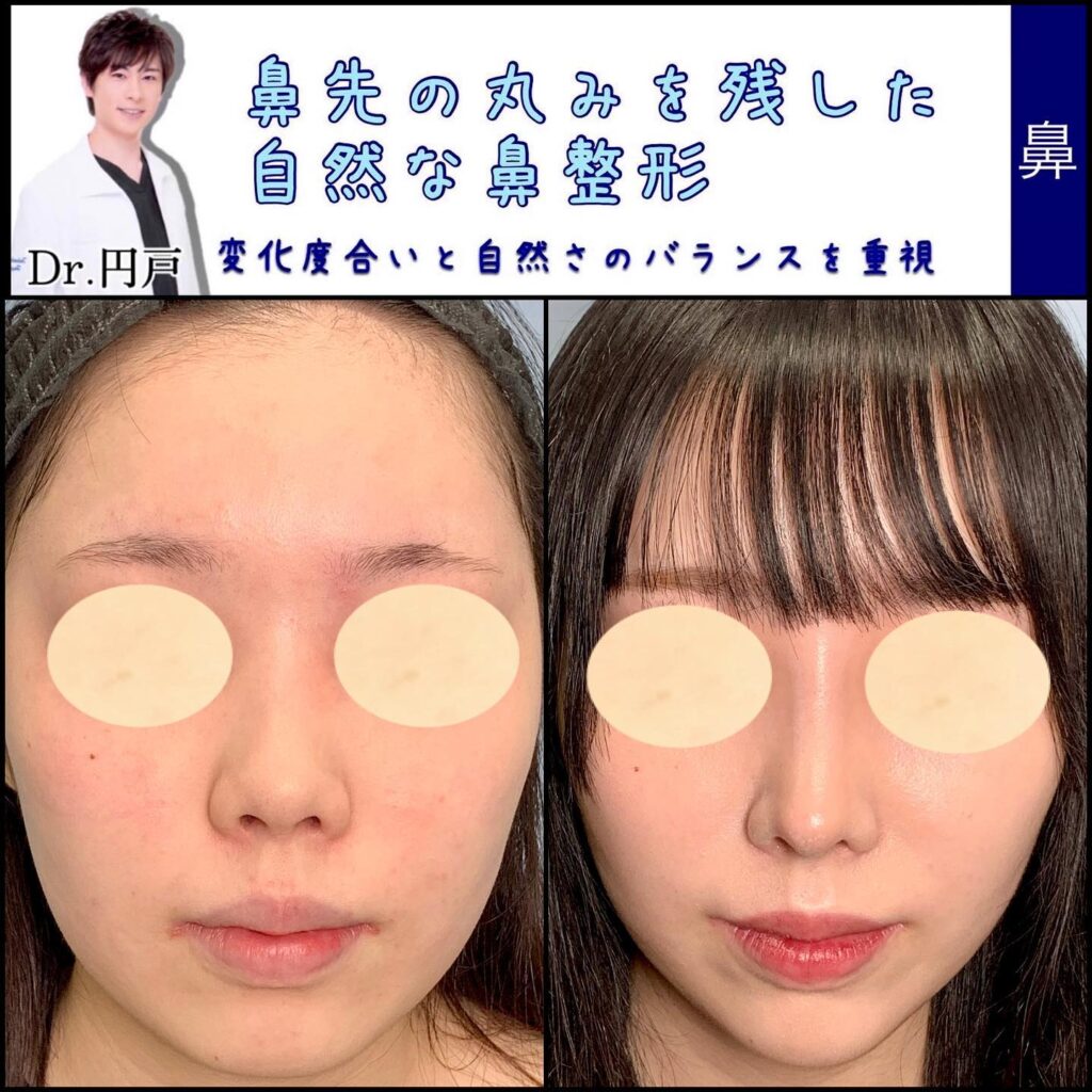 鼻中隔延長と軟骨移植と鼻尖形成とプロテーゼの症例写真 (1)